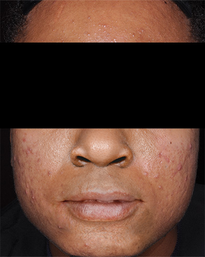 Before And After Face Photos Of FABIOR Patients Showing Improvement At Week 12