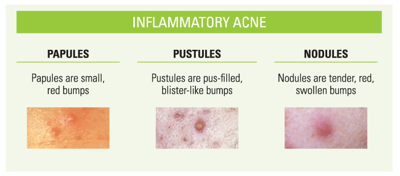 Visual Representation of What Non-inflammatory Acne Looks Like, Including Blackheads And Whiteheads