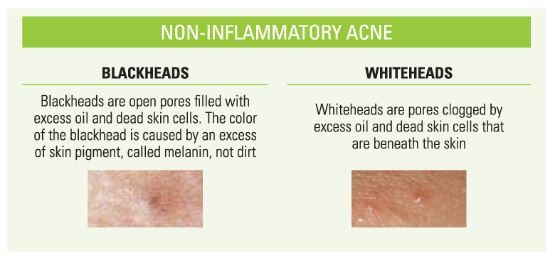 Visual Representation of What Non-inflammatory Acne Looks Like, Including Blackheads And Whiteheads